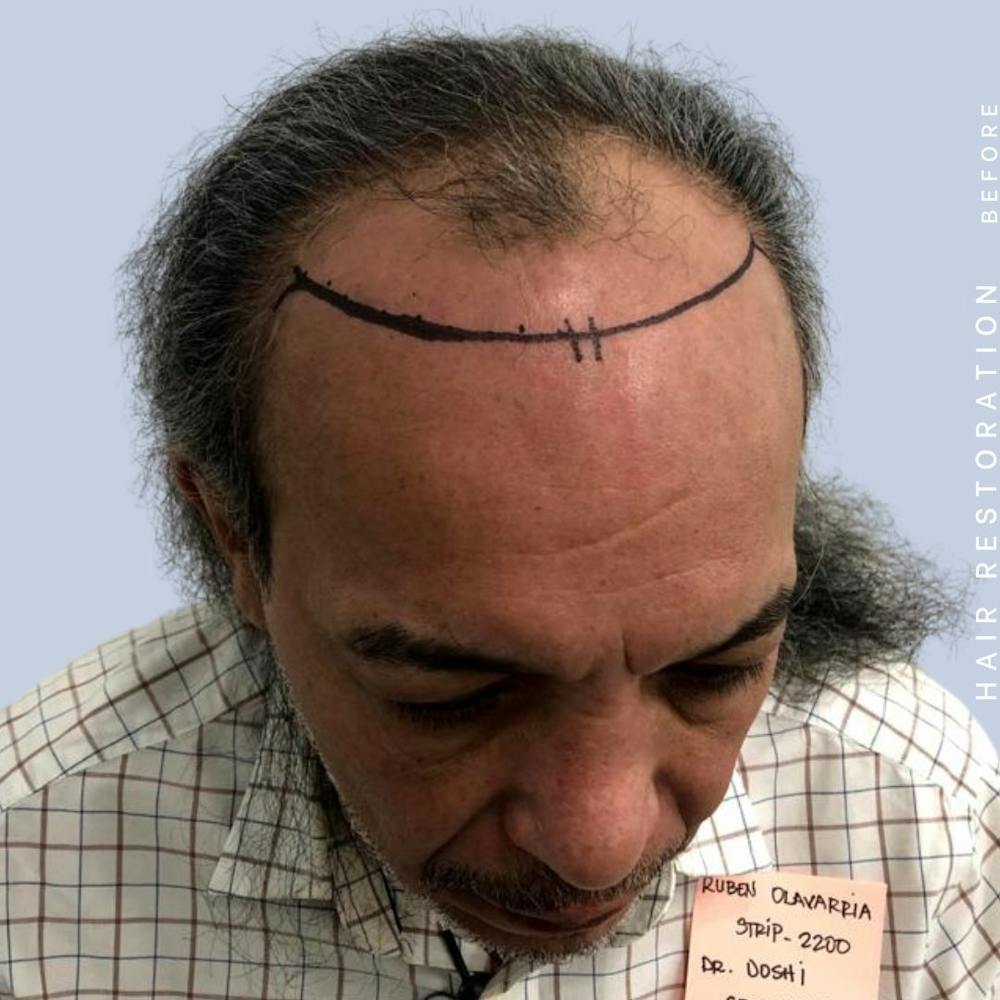 Hair Restoration Before & After Gallery - Patient 108743800 - Image 5