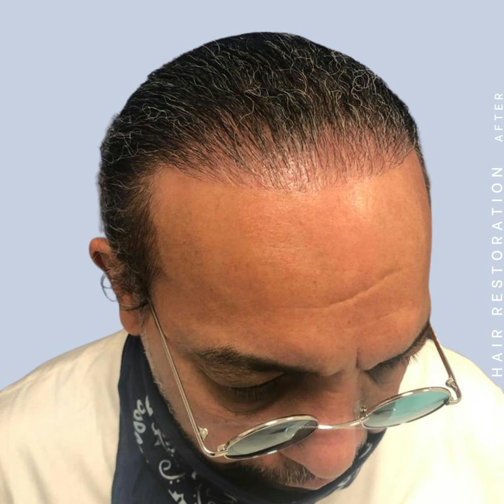 Hair Restoration Before & After Gallery - Patient 108743800 - Image 6