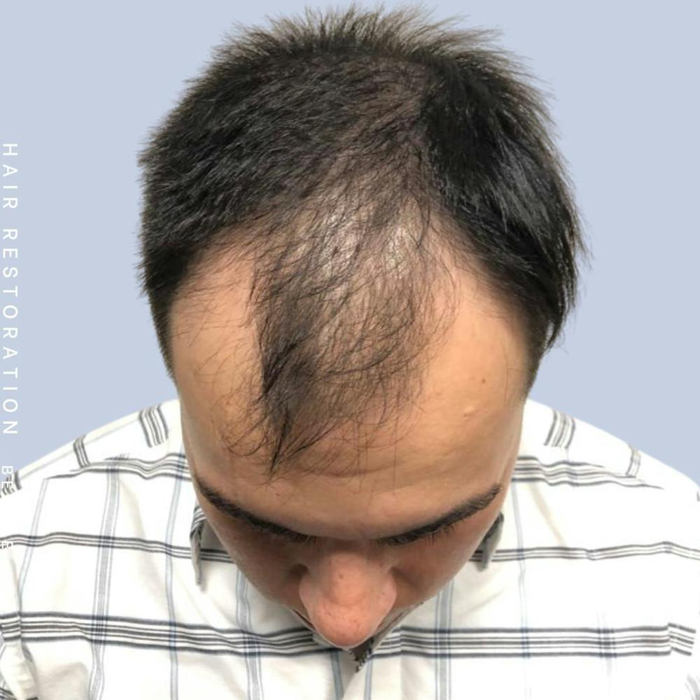 Hair Restoration Before & After Gallery - Patient 108745193 - Image 1