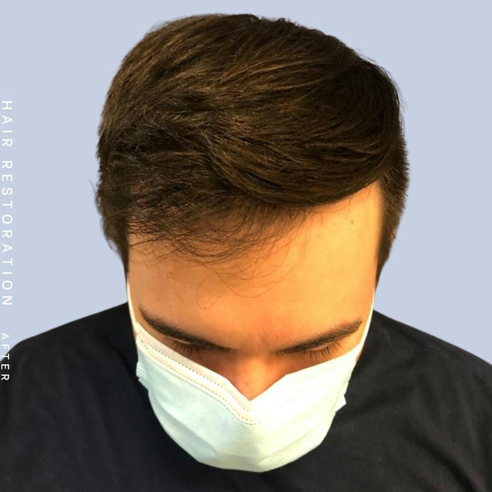 Hair Before & After Gallery - Patient 108745185 - Image 2