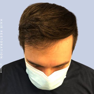 Hair Before & After Gallery - Patient 108745185 - Image 2