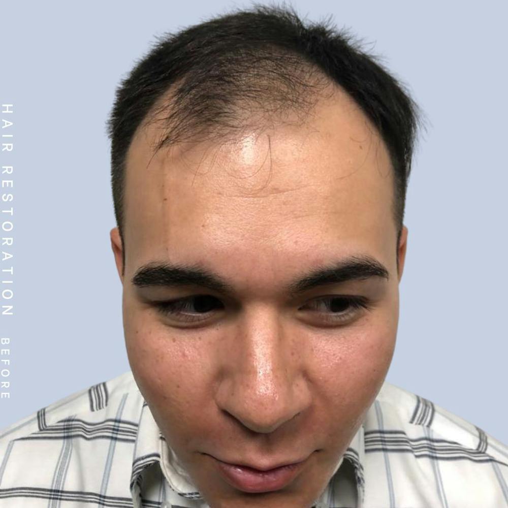 Men's Hair Before & After Gallery - Patient 108745185 - Image 3