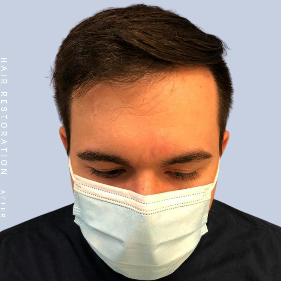 Hair Restoration Before & After Gallery - Patient 108745193 - Image 4