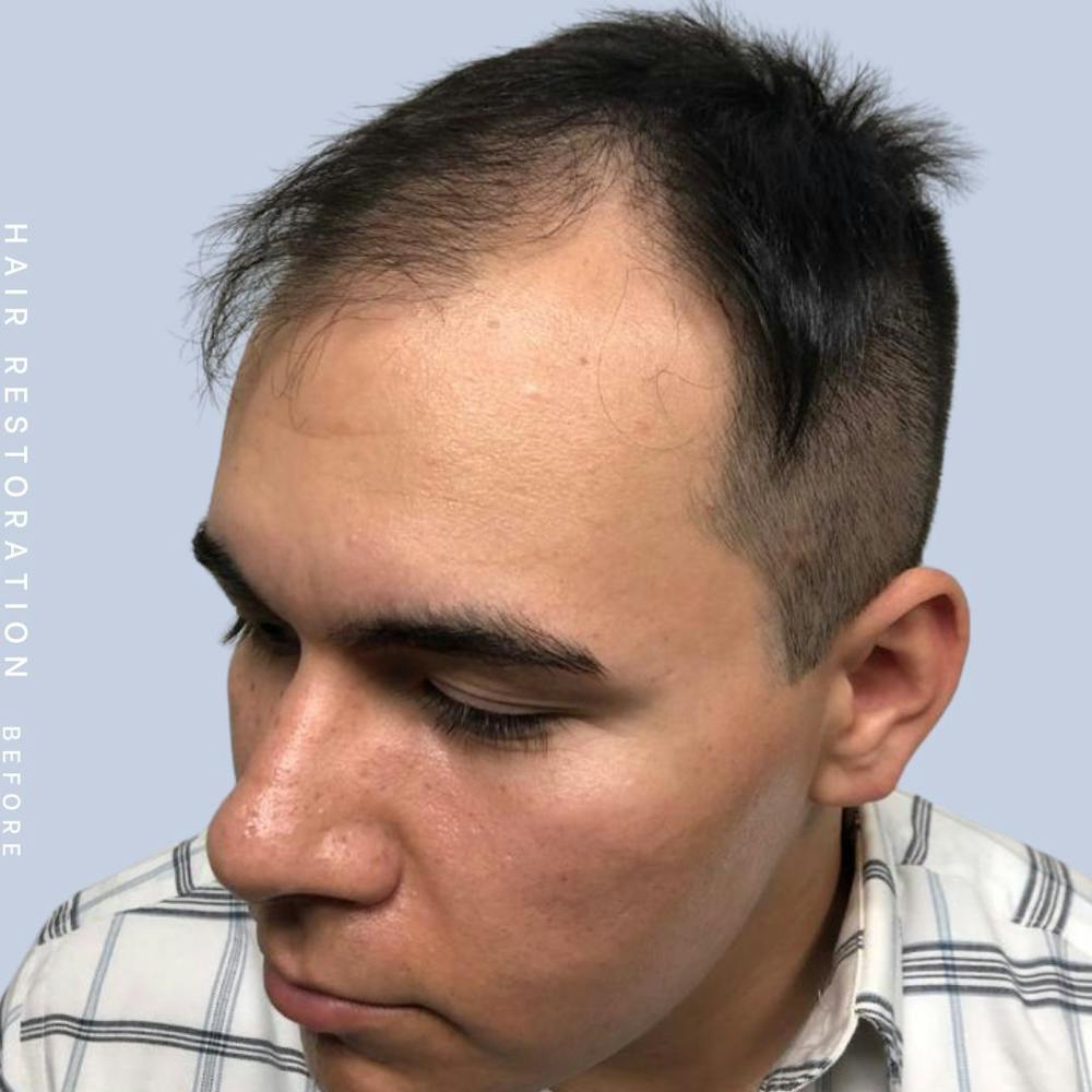 Men's Hair Before & After Gallery - Patient 108745185 - Image 5