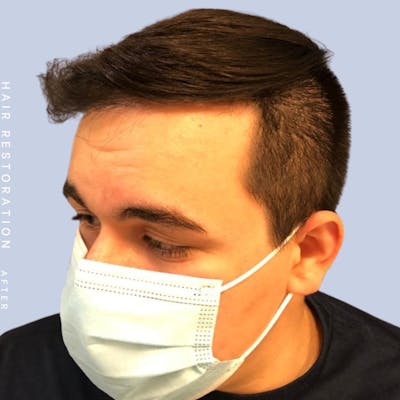 Hair Before & After Gallery - Patient 108745185 - Image 6