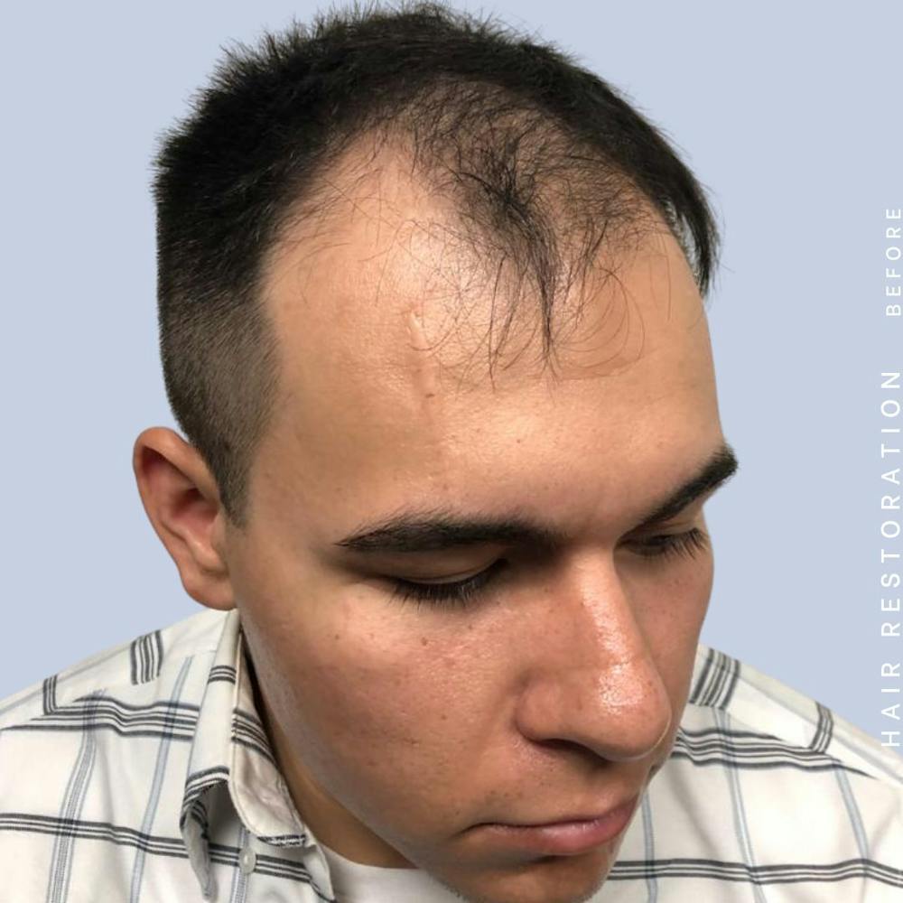 Hair Before & After Gallery - Patient 108745185 - Image 7