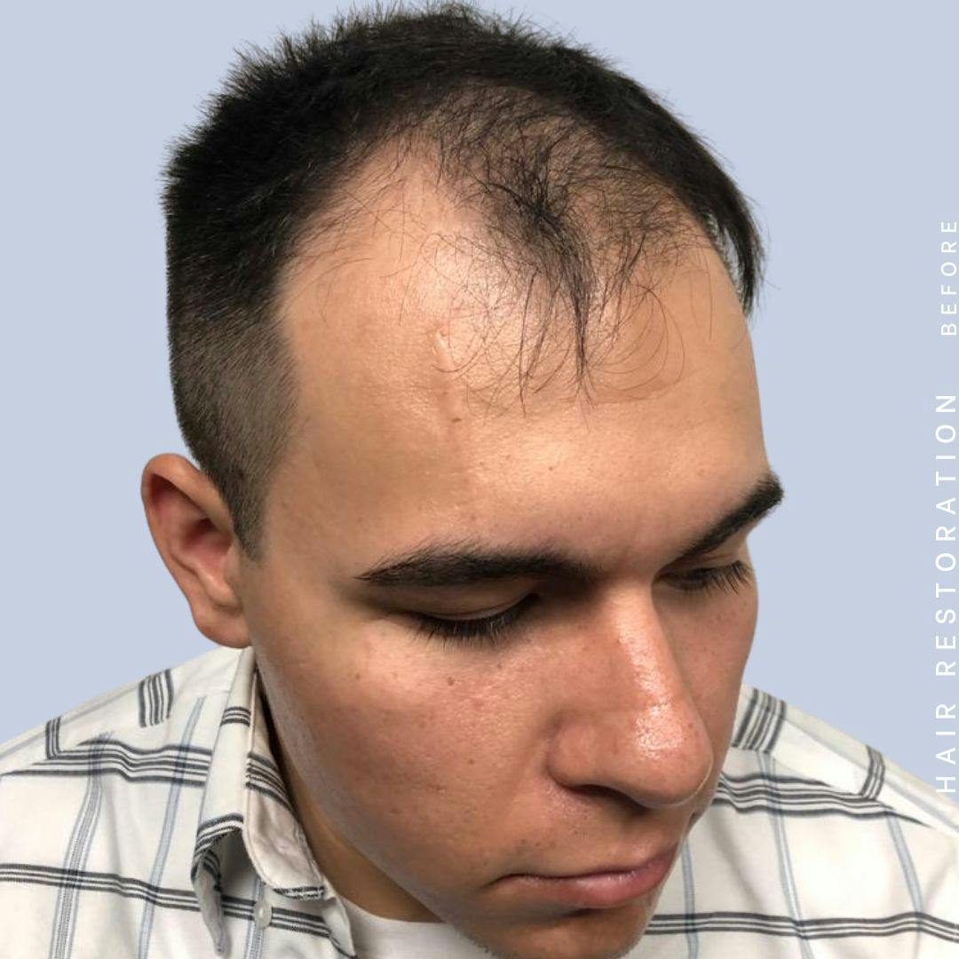 Hair Restoration Before & After Gallery - Patient 108745193 - Image 7