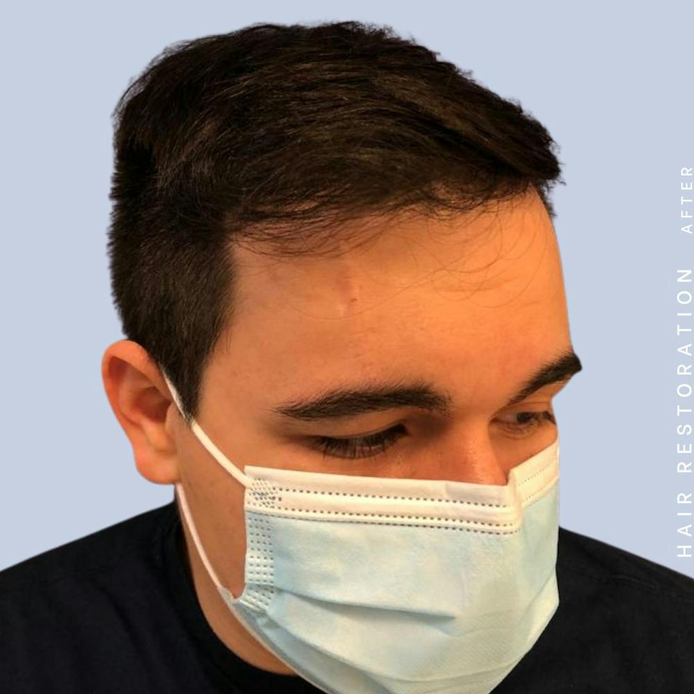 Hair Before & After Gallery - Patient 108745185 - Image 8