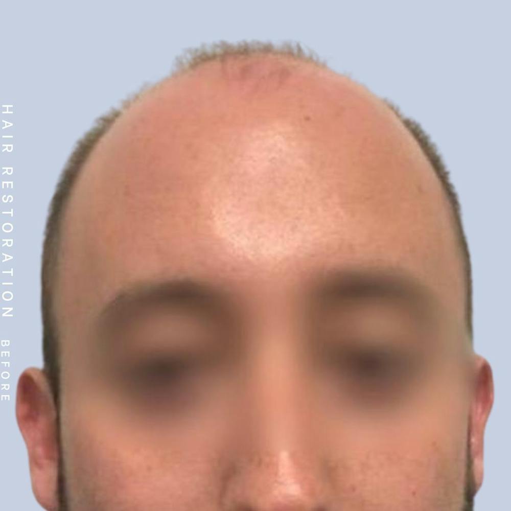 Hair Before & After Gallery - Patient 108745186 - Image 1