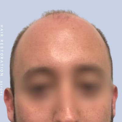 Hair Restoration Before & After Gallery - Patient 108743801 - Image 1