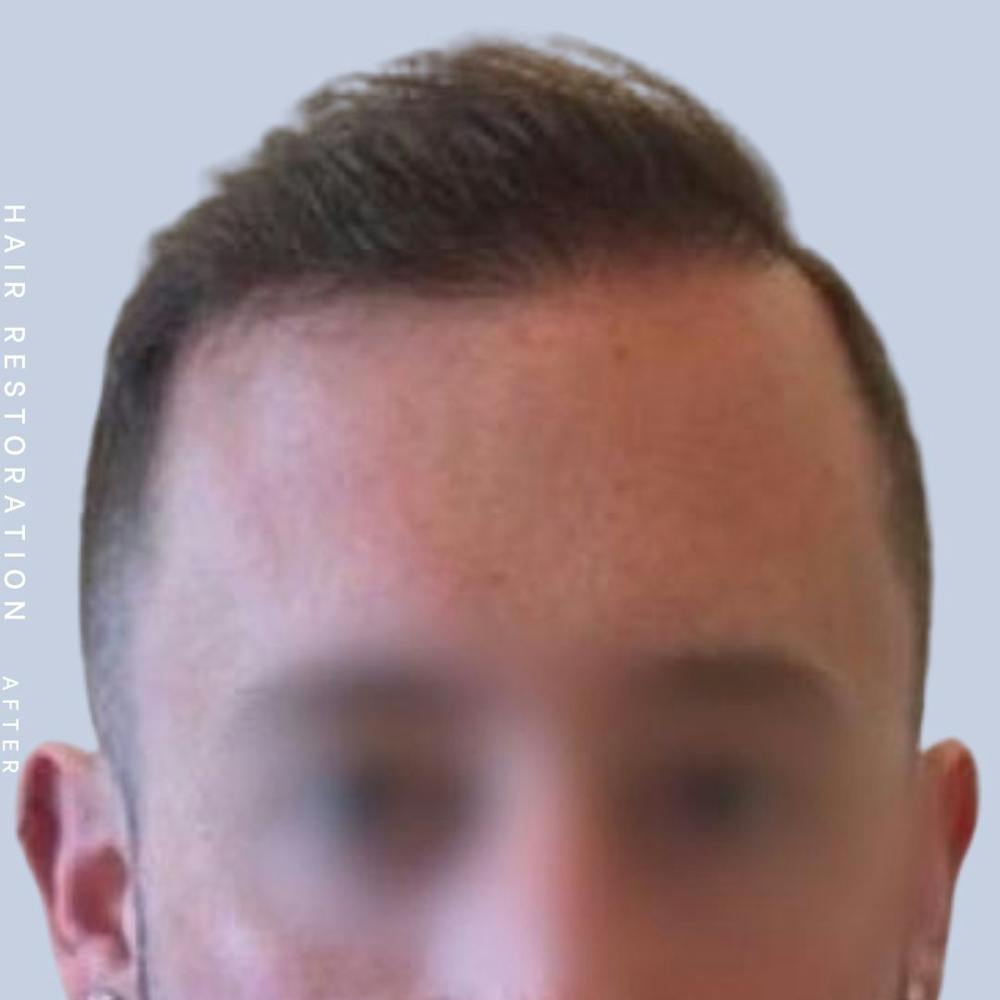 Hair Restoration Before & After Gallery - Patient 108743801 - Image 2