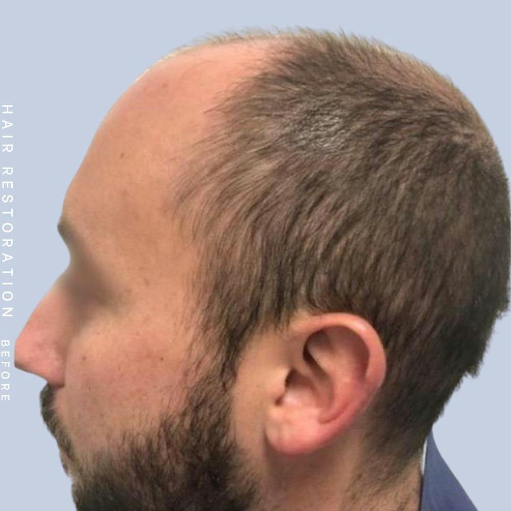 Hair Before & After Gallery - Patient 108745186 - Image 3
