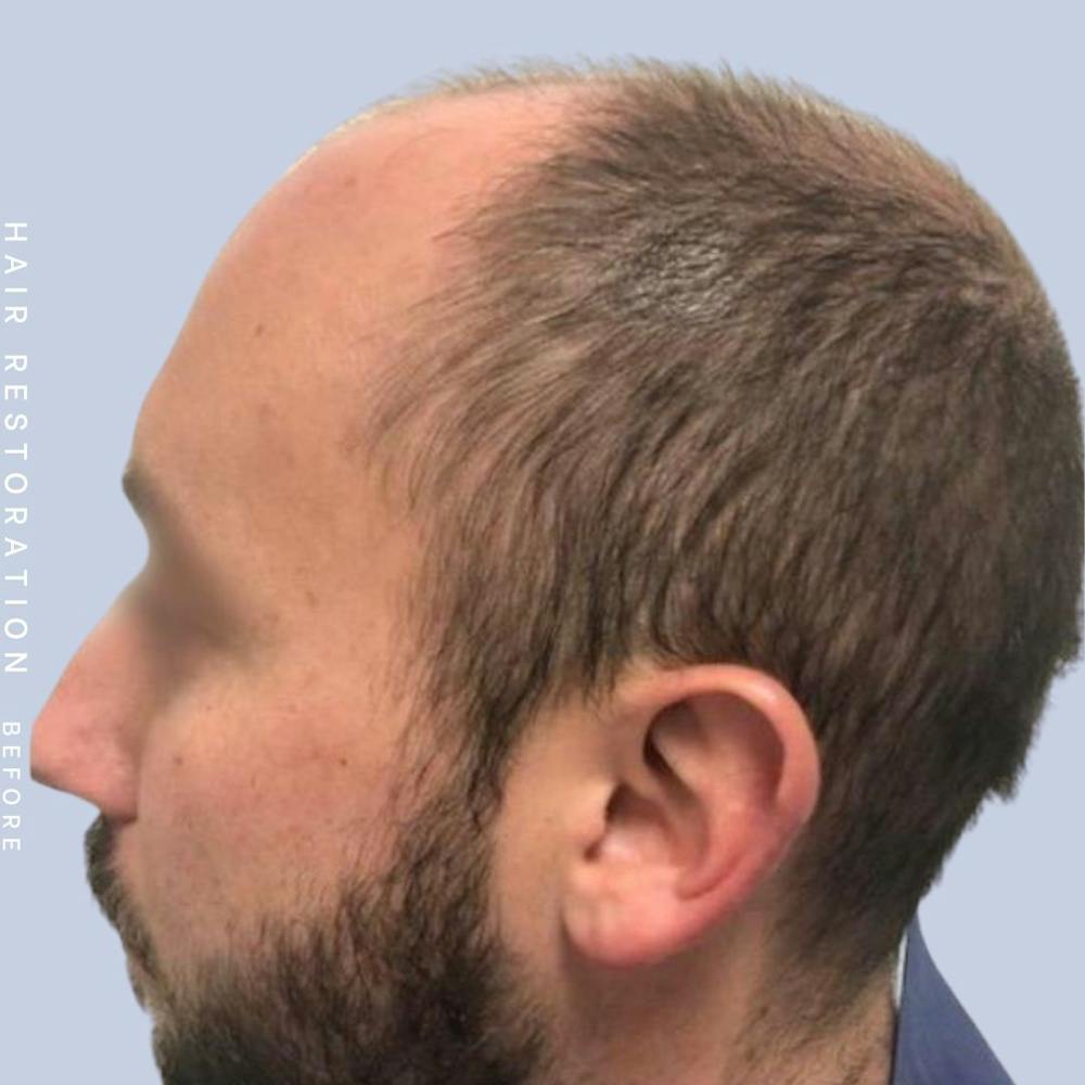 Hair Restoration Gallery - Patient 108743801 - Image 3