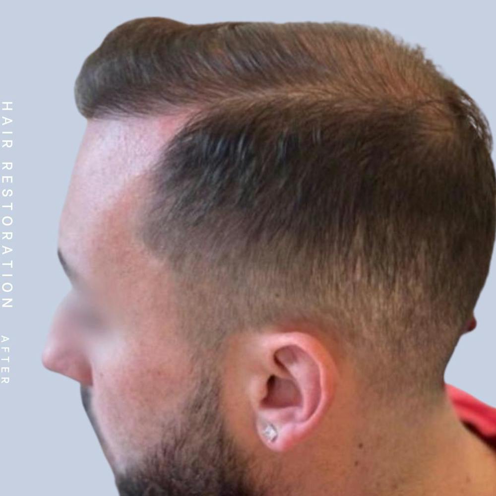 Men's Hair Before & After Gallery - Patient 108745186 - Image 4