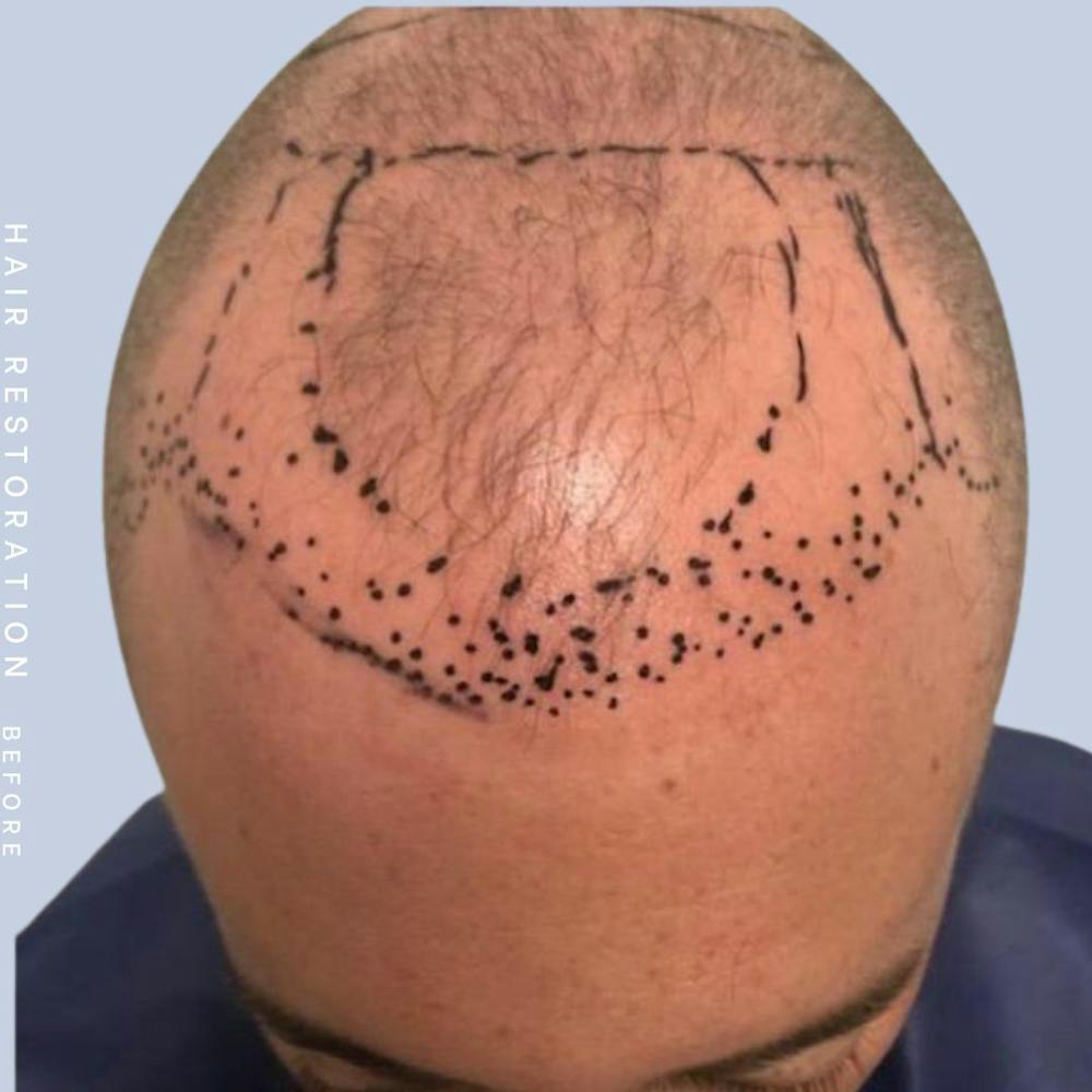 Hair Restoration Before & After Gallery - Patient 108743801 - Image 5