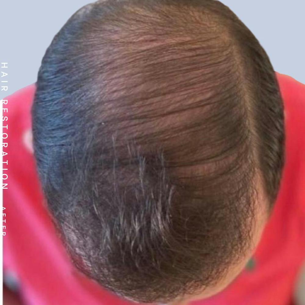Hair Restoration Before & After Gallery - Patient 108743801 - Image 6