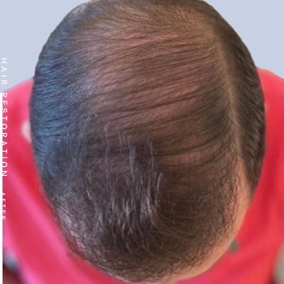 Men's Hair Before & After Gallery - Patient 108745186 - Image 6