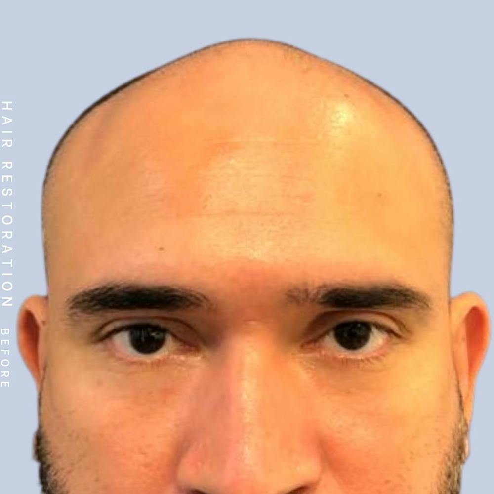 Hair Restoration Before & After Gallery - Patient 117573315 - Image 1