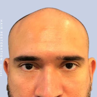Men's Hair Before & After Gallery - Patient 117573311 - Image 1