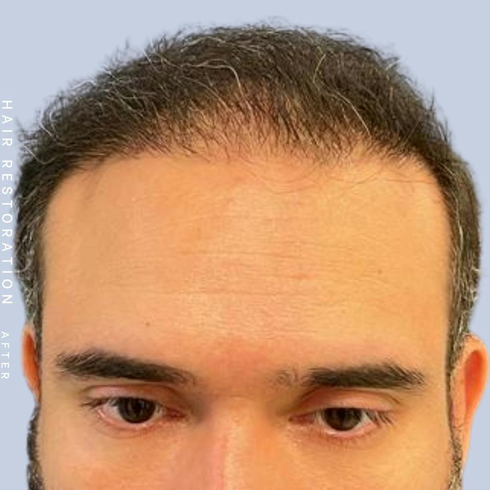 Hair Restoration Before & After Gallery - Patient 117573315 - Image 2