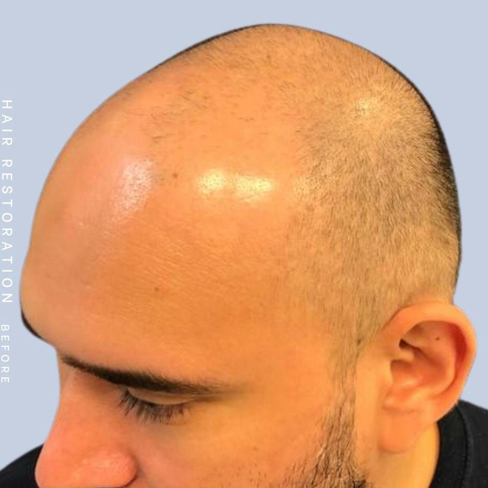 Hair Restoration Before & After Gallery - Patient 117573315 - Image 3