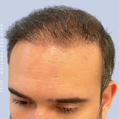 Hair Restoration Before & After Gallery - Patient 117573315 - Image 4