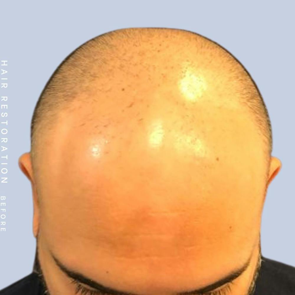 Hair Restoration Before & After Gallery - Patient 117573315 - Image 5