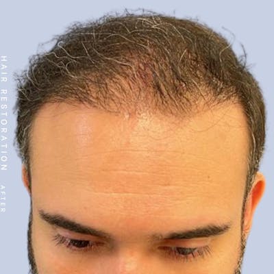 Men's Hair Before & After Gallery - Patient 117573311 - Image 6