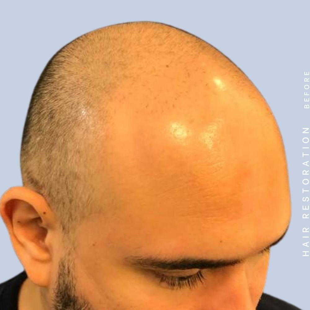 Hair Restoration Before & After Gallery - Patient 117573315 - Image 7