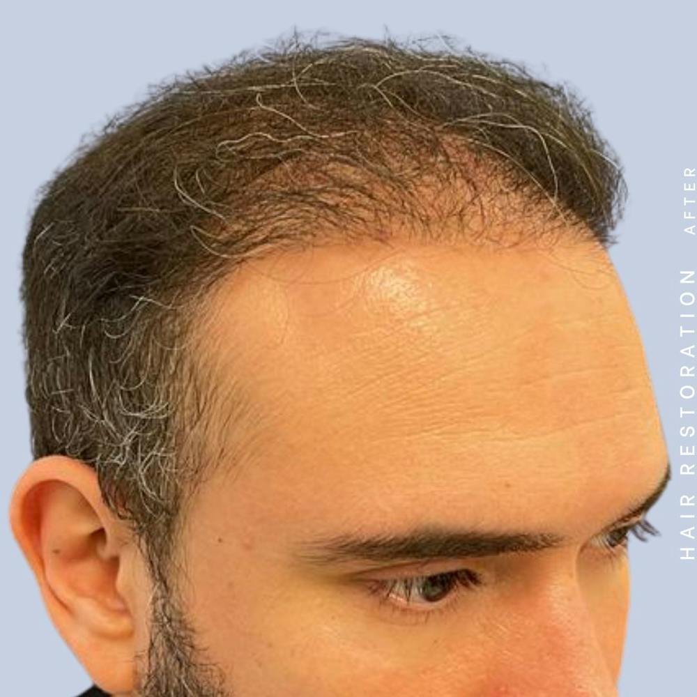 Hair Restoration Before & After Gallery - Patient 117573315 - Image 8