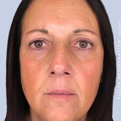 Global Before & After Gallery - Patient 108744249 - Image 1