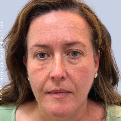 Global Before & After Gallery - Patient 123065088 - Image 1