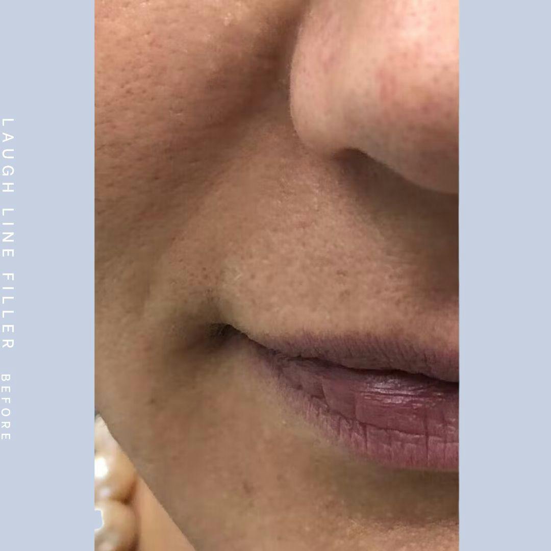 Mouth Before & After Gallery - Patient 108744453 - Image 1