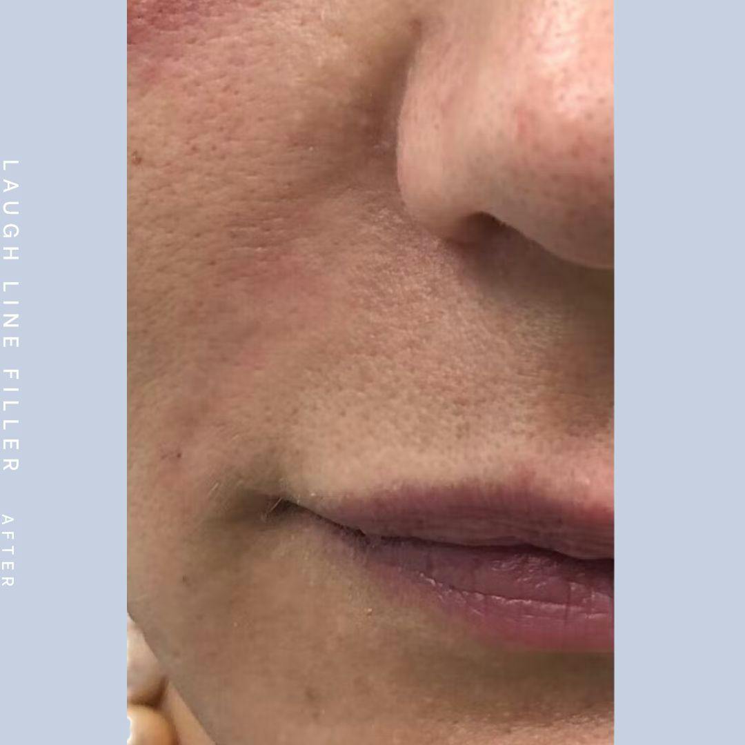 Mouth Before & After Gallery - Patient 108744453 - Image 2