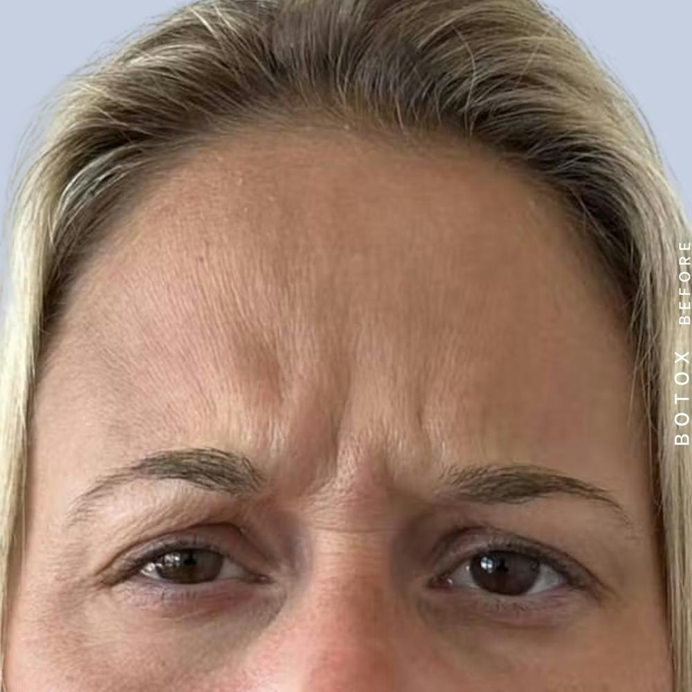Wrinkles Before & After Gallery - Patient 121439087 - Image 1