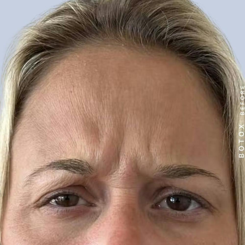 Wrinkles Before & After Gallery - Patient 121439087 - Image 1