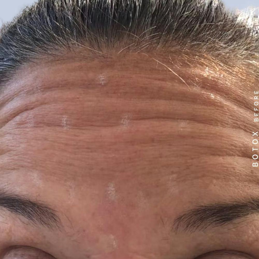 Wrinkles Before & After Gallery - Patient 121356640 - Image 1