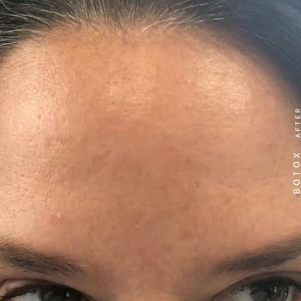 Wrinkles Before & After Gallery - Patient 121356640 - Image 2