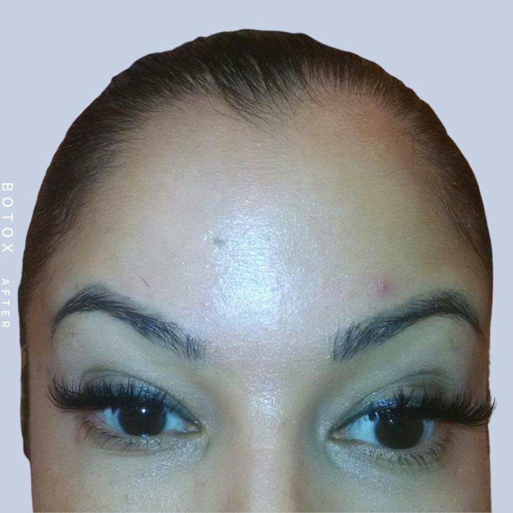 Wrinkles Before & After Gallery - Patient 108744900 - Image 2
