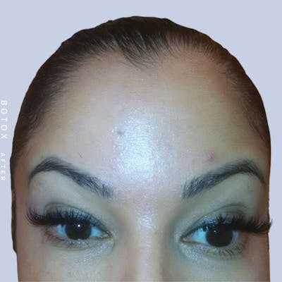 Wrinkles Before & After Gallery - Patient 108744900 - Image 2