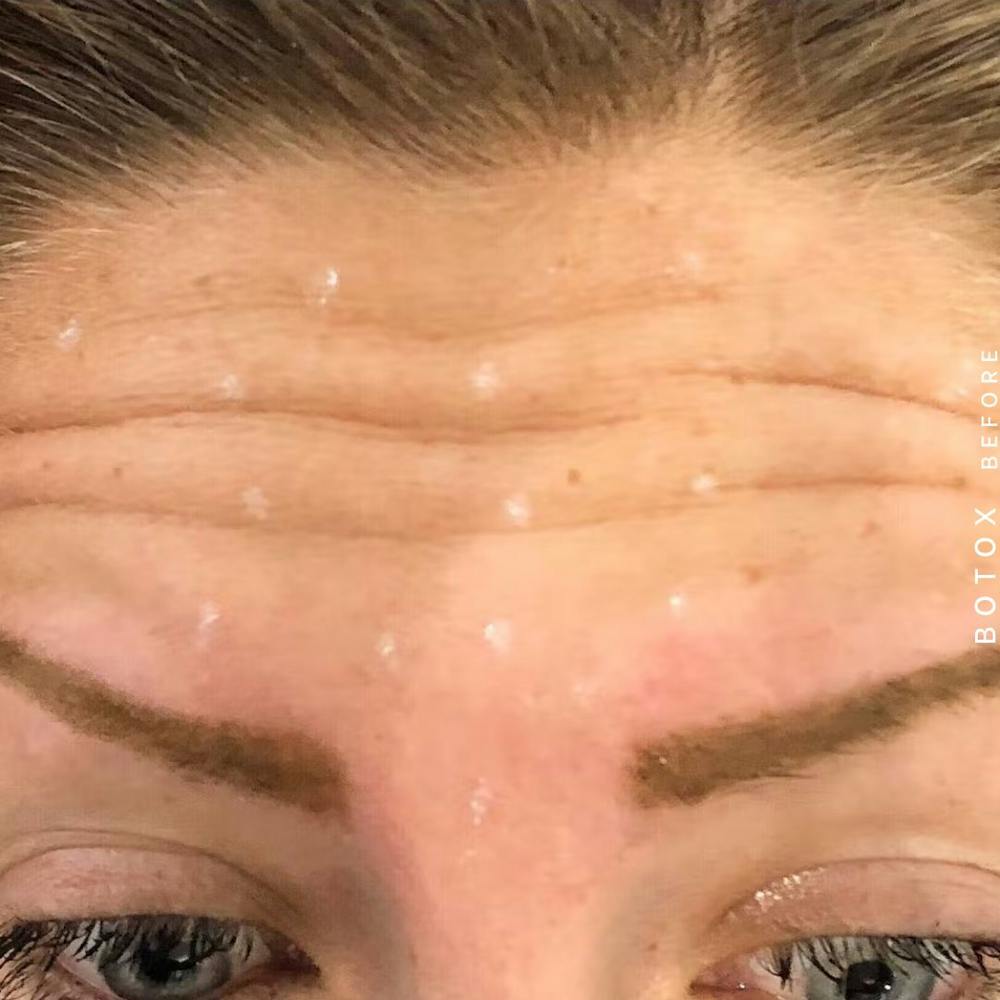 Wrinkles Before & After Gallery - Patient 108744901 - Image 1