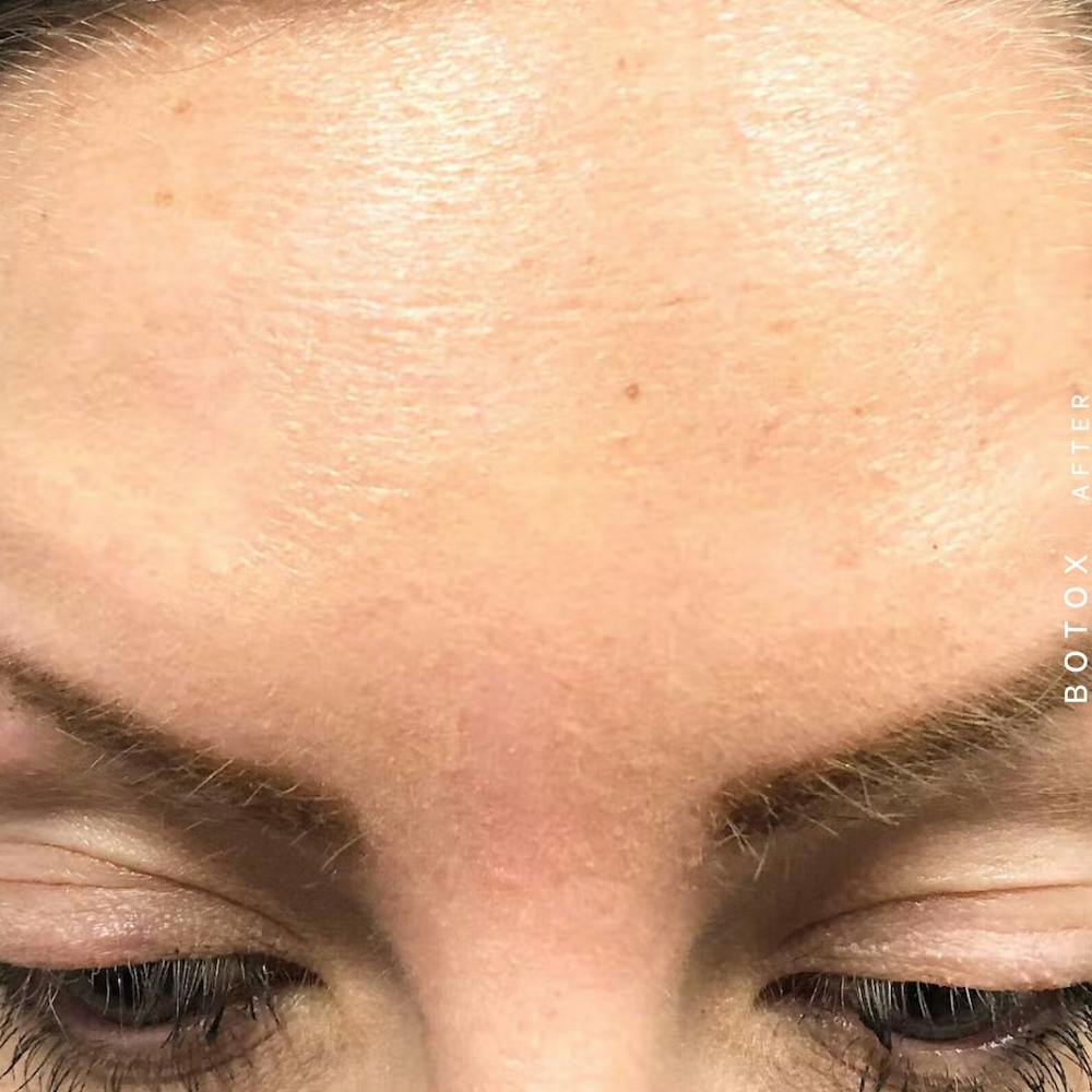 Wrinkles Before & After Gallery - Patient 108744901 - Image 2