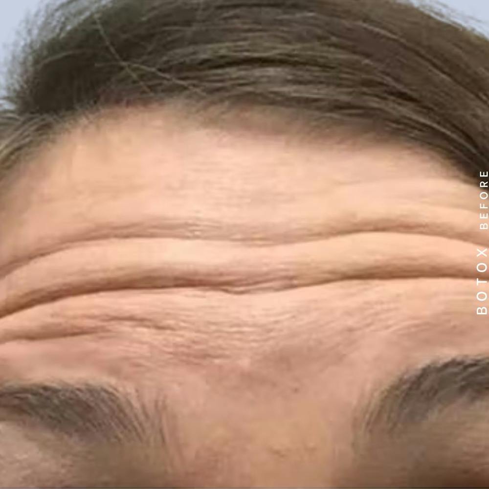 Wrinkles Before & After Gallery - Patient 120946426 - Image 1