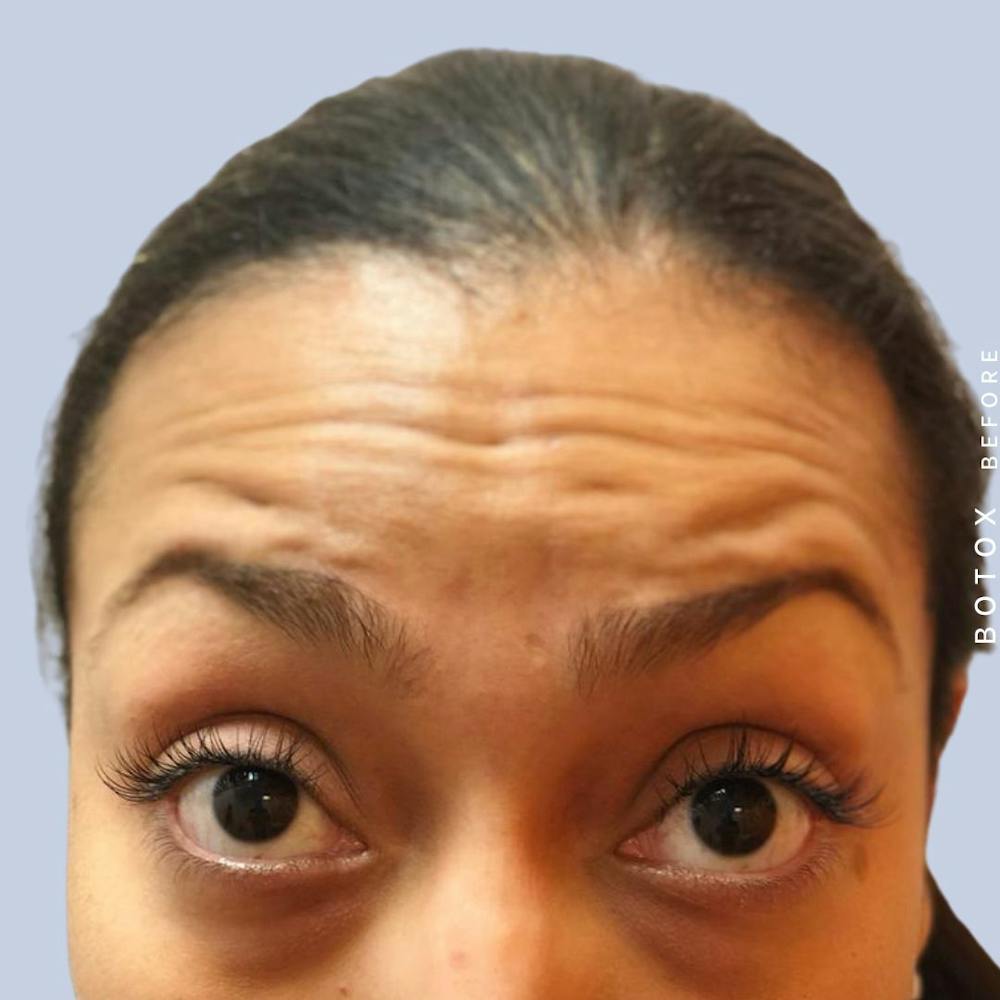 Wrinkles Before & After Gallery - Patient 121122015 - Image 1