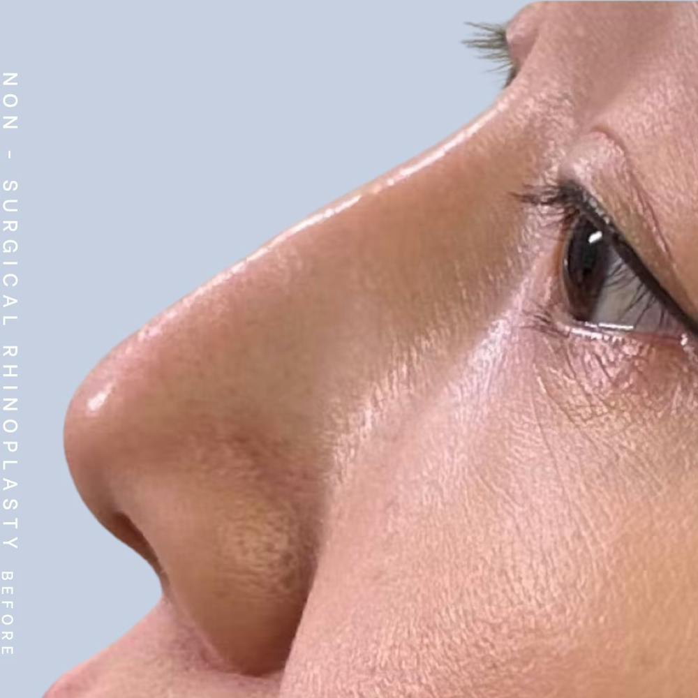 Non-Surgical Nose Before & After Gallery - Patient 123000360 - Image 1