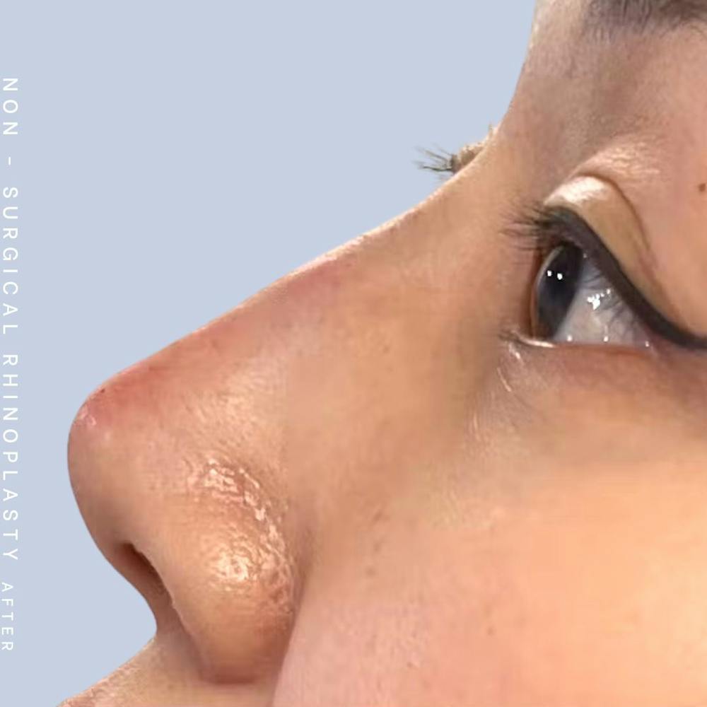 Non-Surgical Nose Before & After Gallery - Patient 123000360 - Image 2