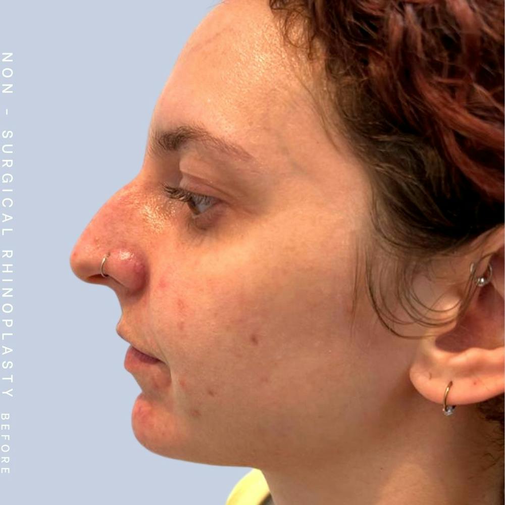 Nose Before & After Gallery - Patient 122852138 - Image 1