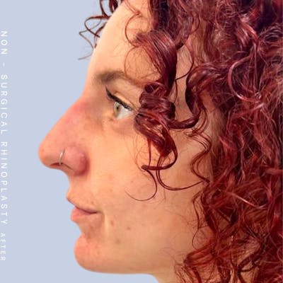 Non-Surgical Nose Before & After Gallery - Patient 122852138 - Image 2