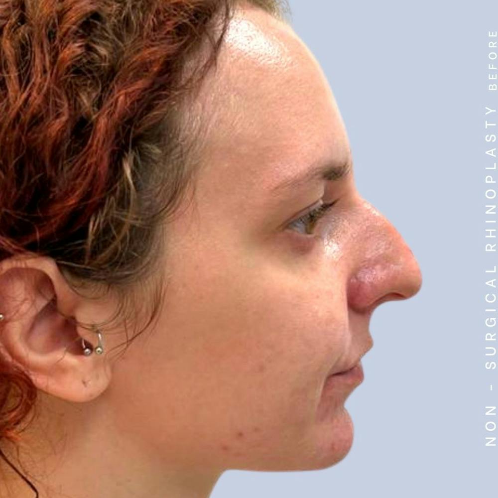Non-Surgical Nose Before & After Gallery - Patient 122852138 - Image 3