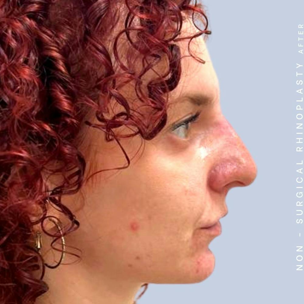Nose Before & After Gallery - Patient 122852138 - Image 4